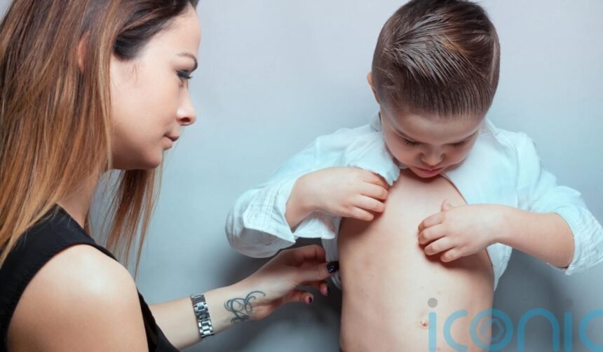 6 subtle warning signs of measles in children – and how to prevent it